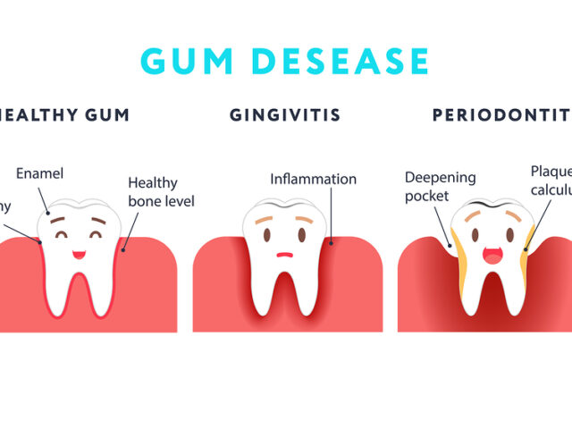 https://melmedhealth.com/wp-content/uploads/2024/01/gum-disease-640x480.jpg