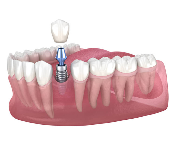 https://melmedhealth.com/wp-content/uploads/2024/02/Single-Tooth-Dental-Implant.jpg