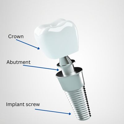 https://melmedhealth.com/wp-content/uploads/2024/02/dental-implant-metairie-la.jpg