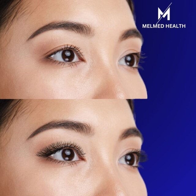 https://melmedhealth.com/wp-content/uploads/2024/02/melmed-BROWS-LIFT-1-640x640.jpg