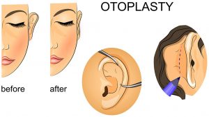 https://melmedhealth.com/wp-content/uploads/2024/03/Ear-Surgery-300x169-1.jpg