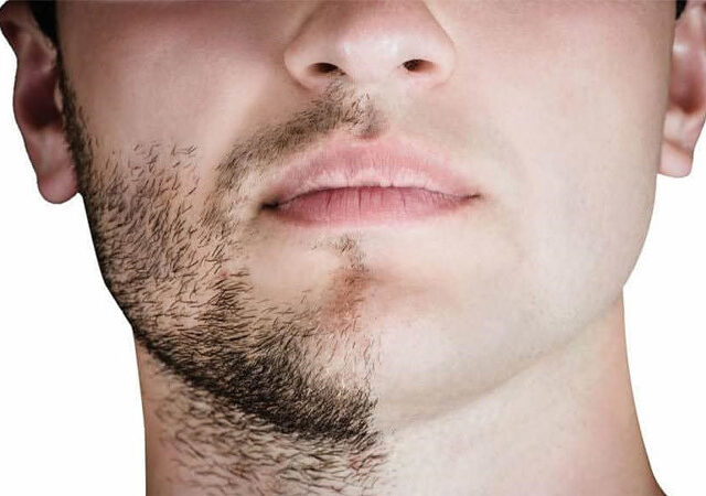 https://melmedhealth.com/wp-content/uploads/2024/03/Facial-Hair-Transplant-msg-640x450.jpg