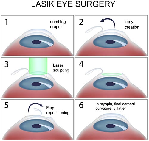 https://melmedhealth.com/wp-content/uploads/2024/03/LASIK-Eye-Surgery-procedure-NYC.jpg