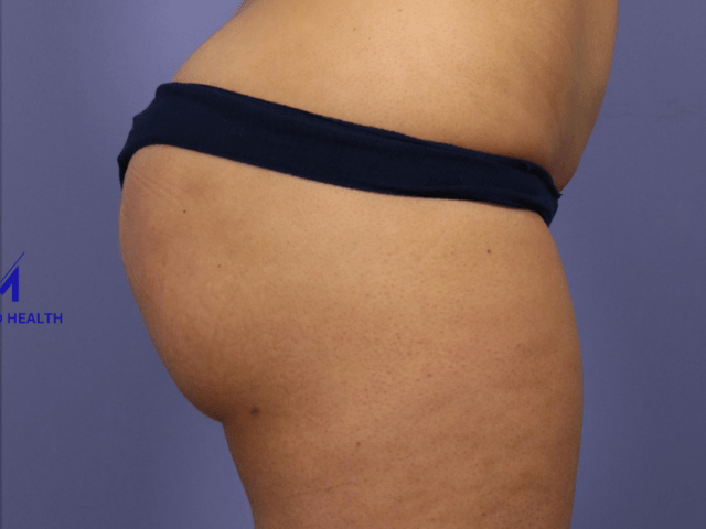 https://melmedhealth.com/wp-content/uploads/2024/03/brazilian-butt-lift-fat-grafts-to-buttocks-624-view-1-detail-1-640x480.png