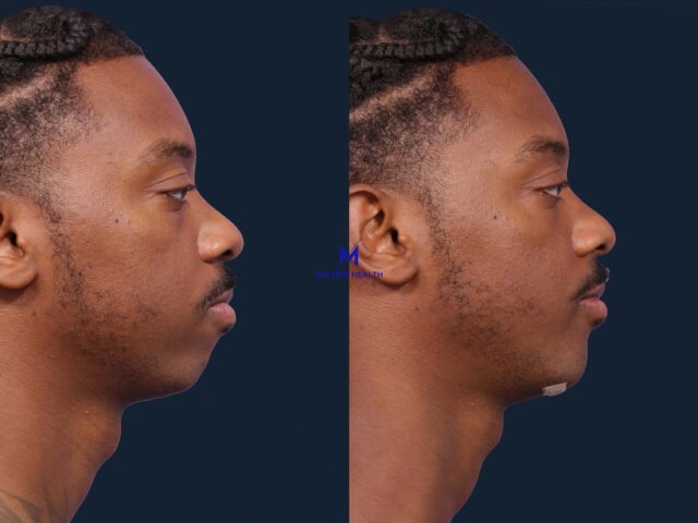 https://melmedhealth.com/wp-content/uploads/2024/03/chin-augmentation-1904-right-side-detail-640x480.jpg