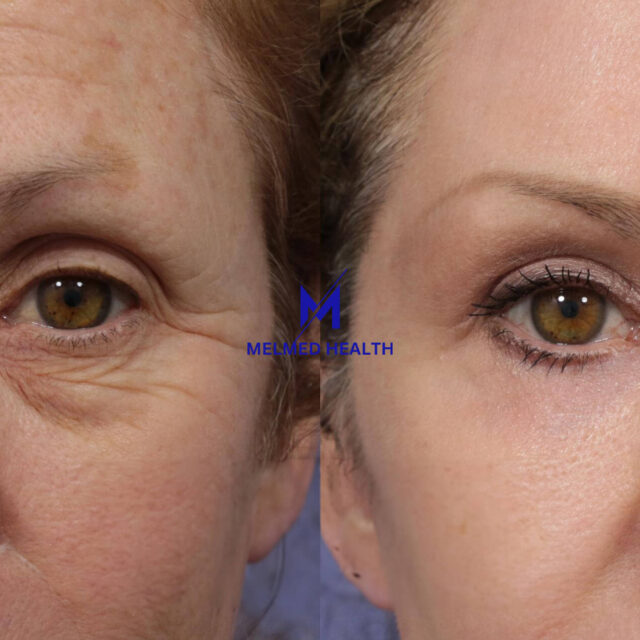 https://melmedhealth.com/wp-content/uploads/2024/03/laser-skin-resurfacing-916-view-1-detail-640x640.jpg