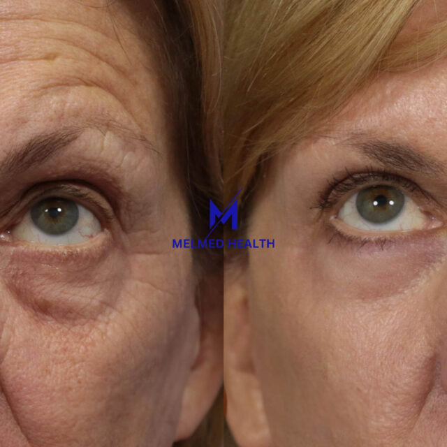 https://melmedhealth.com/wp-content/uploads/2024/03/laser-skin-resurfacing-923-view-1-detail-640x640.jpg