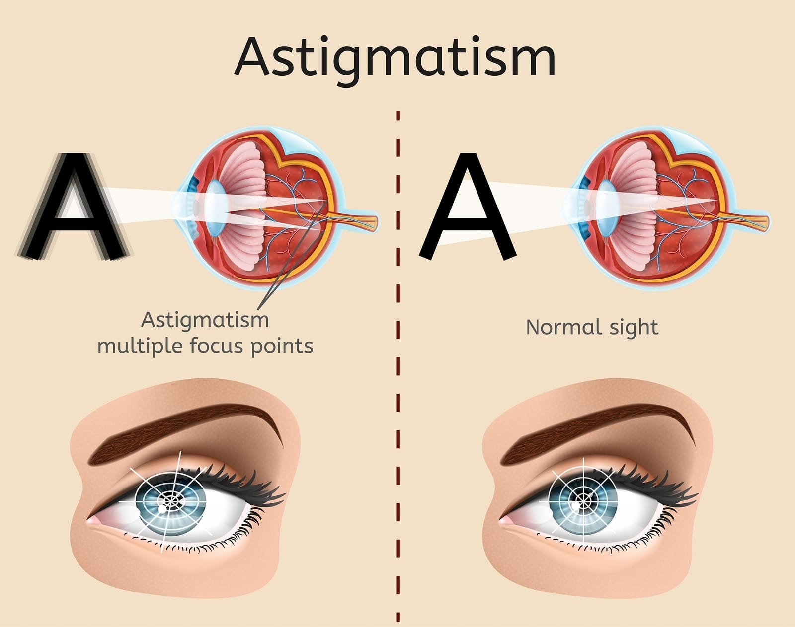 https://melmedhealth.com/wp-content/uploads/2024/03/lasik-eye.jpg