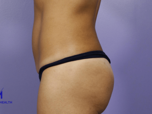 https://melmedhealth.com/wp-content/uploads/2024/03/liposuction-1071-view-1-detail-1-640x480.png