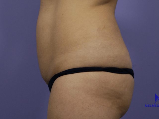 https://melmedhealth.com/wp-content/uploads/2024/03/liposuction-1071-view-1-detail-640x480.png