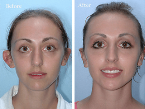 https://melmedhealth.com/wp-content/uploads/2024/03/otoplasty-pic.png